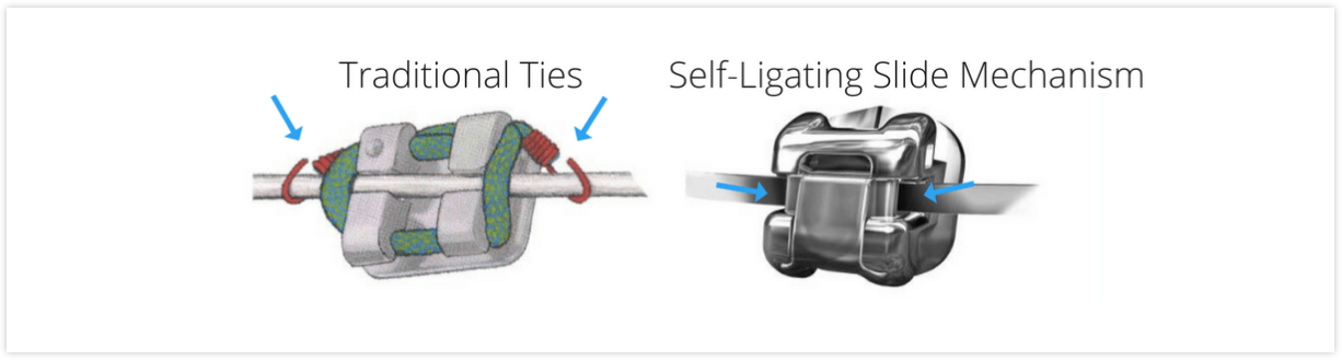 Self-Ligating Metal Braces