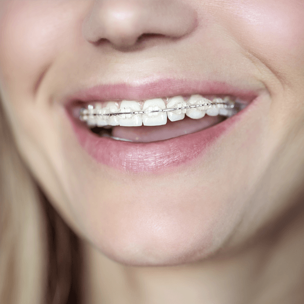 Clear Braces