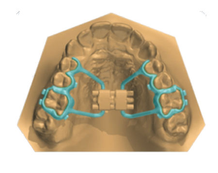 3D Printed Orthodontic Appliances